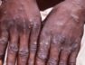 92-monkeypox-cases-confirmed-in-12-countries-may-spread-globally-who-latest-eng-news-1476317