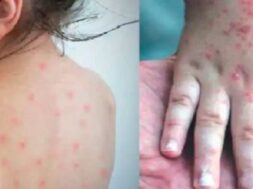 measles in gujarati