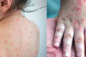 measles in gujarati